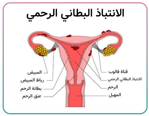 الانتباذ البطاني الرحمي.. ألم صامت يهدد خصوبة النساء