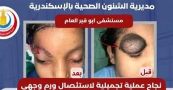   مستشفى أبو قير تنجح في إزالة ورم ملون من وجه طفلة