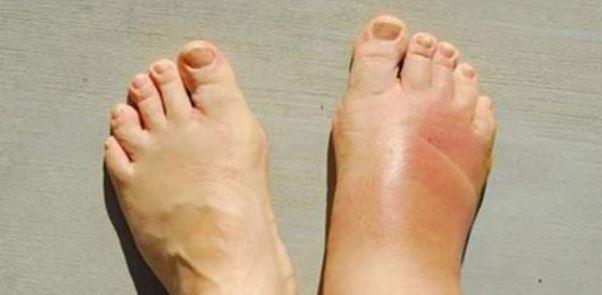 احتباس السوائل في الجسم… علامات لا يجب تجاهلها