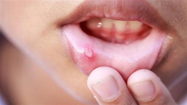 أعراض الهربس الفموي وطرق تعزيز مناعة الأطفال