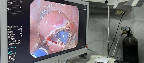 نجاح الطاقم الطبي بمستشفى منيا القمح فى إجراء تدخلات متطورة بتقنية الفراغ الثالث