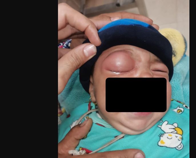 عيون سوهاج الجامعي ينجح في إنقاذ عين رضيعة تبلغ من العمر 6 أشهر