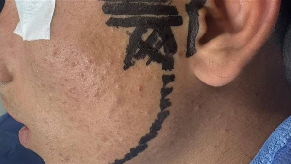 إجراء جراحة دقيقة وغير مسبوقة لتحرير مفصل الفك الصدغي (TMJ) لشاب بالإسكندرية