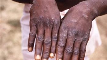   غانا تسجل أول حالة وفاة بفيروس جدري القردة