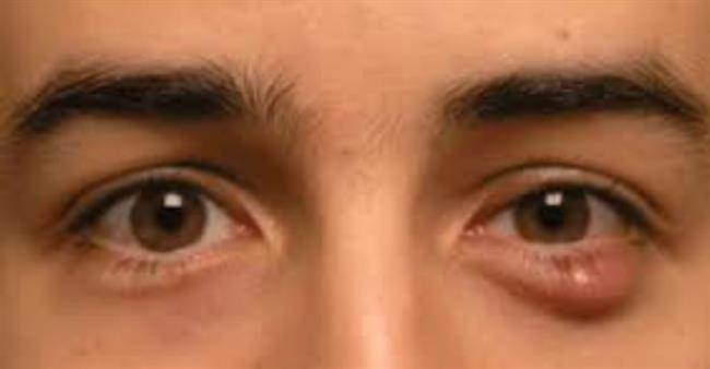 الكيس الدهني في العين: أسباب، علاج، وطرق الوقاية