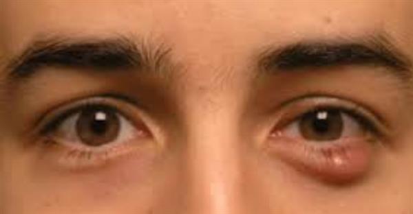 الكيس الدهني في العين: أسباب، علاج، وطرق الوقاية
