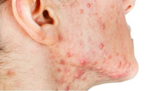 حب الشباب في الجسم: أسباب متعددة وطرق للوقاية والعلاج