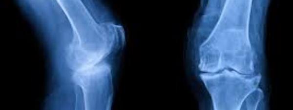 الدكتورة ميرنا شريف: خشونة الركبة مرض مزمن يعيق الحركة ويؤثر على جودة الحياة