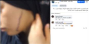   كشف ملابسات مقطع فيديو  تضمن تضرر فتاة من قيام سيدة بالتعدى عليها بآلة حادة