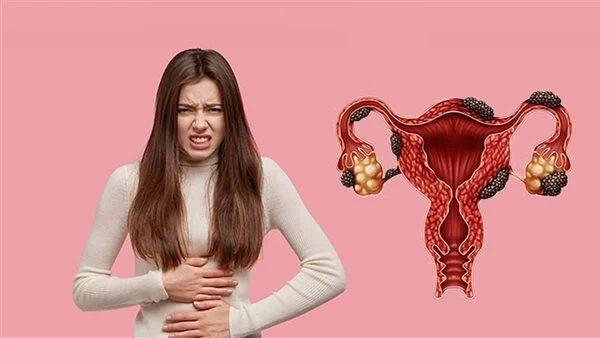 أكياس الشوكولاتة.. العدو الخفي لصحة المرأة والخصوبة