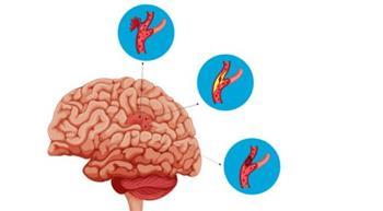 تمدد الأوعية الدموية في الدماغ.. القنبلة الصامتة داخل الرأس