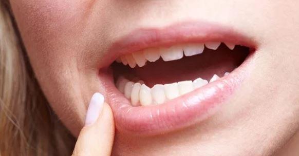 وصفات طبيعية لتخفيف ألام اللثة والتهاب الأسنان في الشتاء