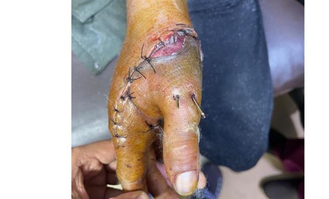 نجاة شاب من بتر الإبهام بعد جراحة 6 ساعات بسوهاج الجامعي