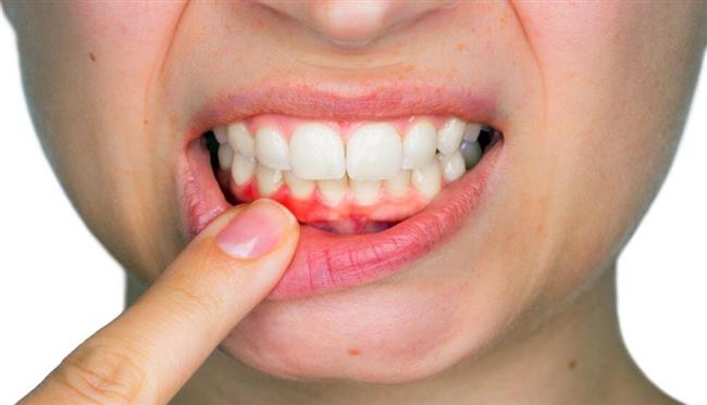 التهاب اللثة بوابة خطيرة لأمراض الفم