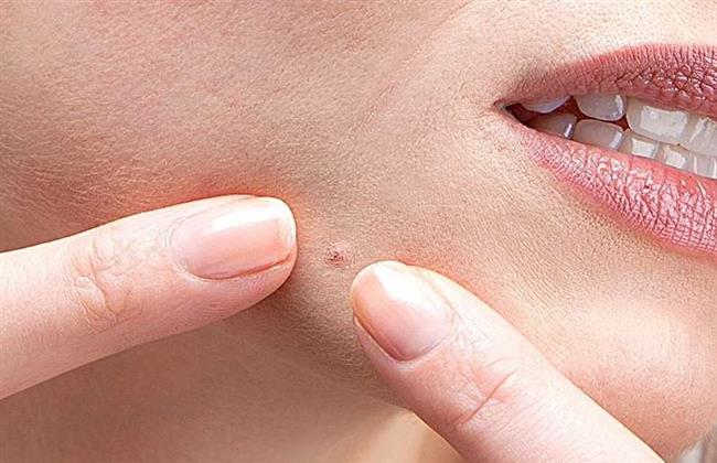 لماذا تتركز البثور أسفل الوجه؟