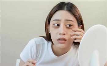   الهالات السوداء في رمضان… لماذا تزداد وكيف يمكن علاجها بطرق آمنة؟
