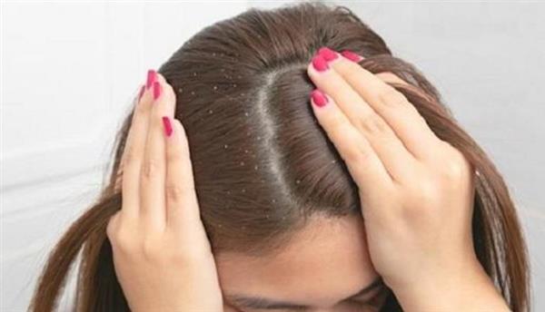 طرق فعالة للتخلص من قشرة الشعر نهائيا