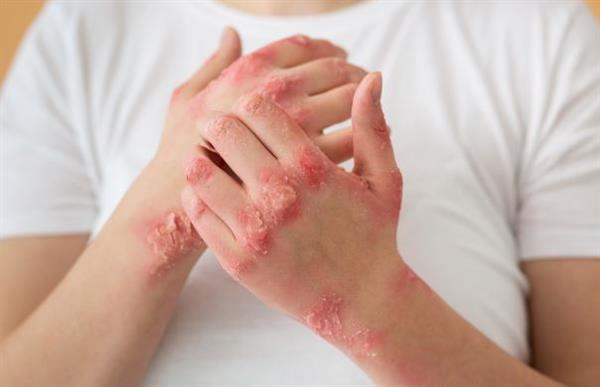 أطعمة تقلل التهاب الصدفية وتحسن صحة الجلد