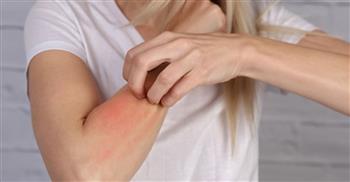   حساسية الجلد أثناء الحمل.. متى تكون طبيعية ومتى تستدعي تدخلا طبيا عاجلا؟