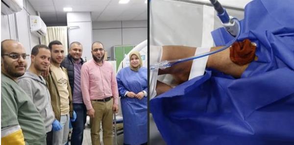 إنجاز طبي ببني سويف.. نجاح كي حراري لعلاج ورم عظمي حميد