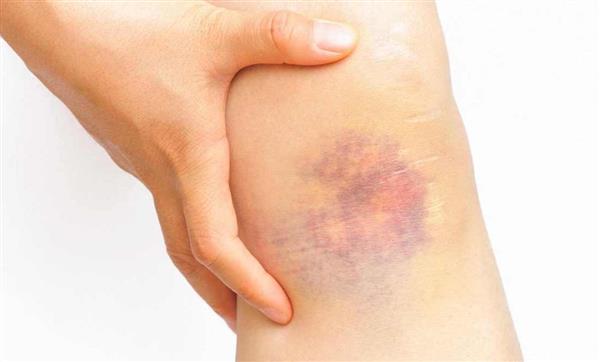 هؤلاء ممنوعون من التبرع لزراعة النخاع والخلايا الجذعية