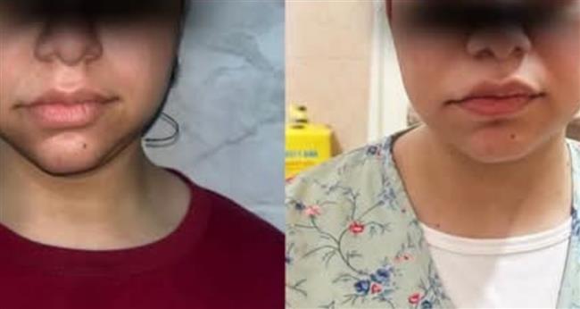مستشفى رأس التين النموذجي تنجح في إجراء أول جراحة شد عميق للوجه