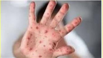   جدري القرود.. الصحة العالمية تحذر من استمرار التفشي عالميًا