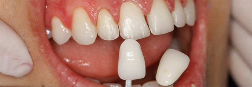   ثورة طبية جديدة.. أسنانك تنمو - طبيعيا - بعد سقوطها فى الشيخوخة