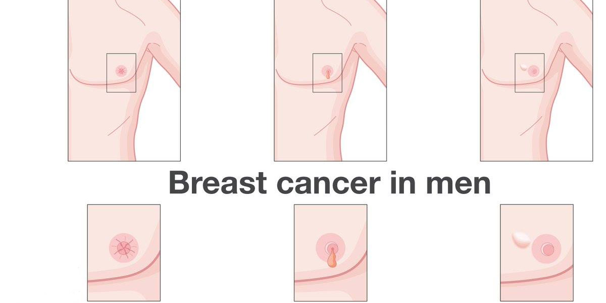   سرطان الثدى يصيب الرجال أيضا