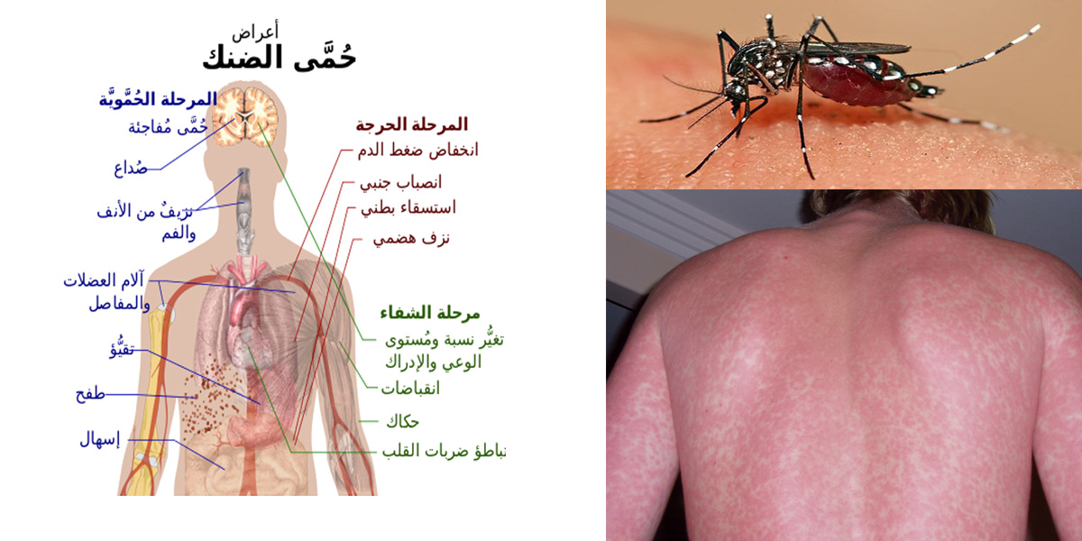   9 وصايا ومعلومات عن «حمى الضنك» يجب أن تعرفها