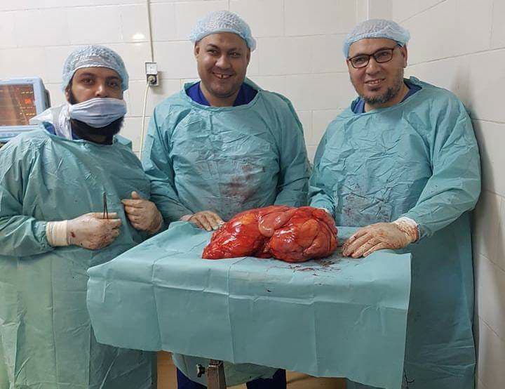   صور| جراحة ناجحة لإستئصال  ورم وزنه 15 كيلو من مريضة فى كفر الشيخ