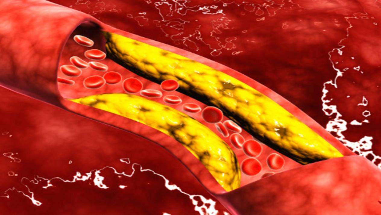   أسباب ارتفاع الكوليسترول فى الدم وطرق الوقاية منه  ؟
