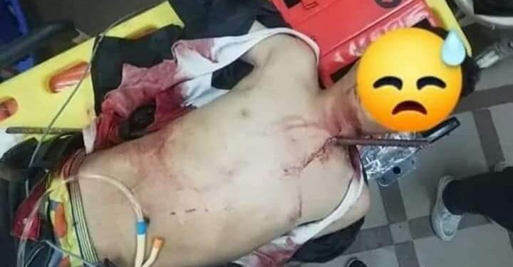   سقوط طفل على سيخ حديد بسبب طيارة ورق