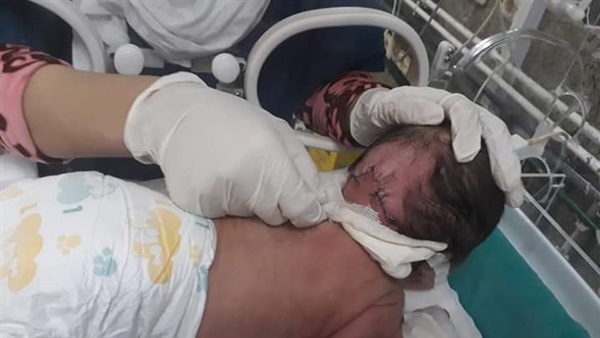   جراحة ناجحة  لطفل بكفر الشيخ ووالده يشكر المسئولين بمستشفى أطفال مصر