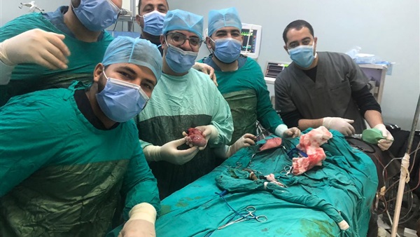   جراحة نادرة بمستشفيات جامعة المنيا لاستئصال توأم مسخي ملتصق