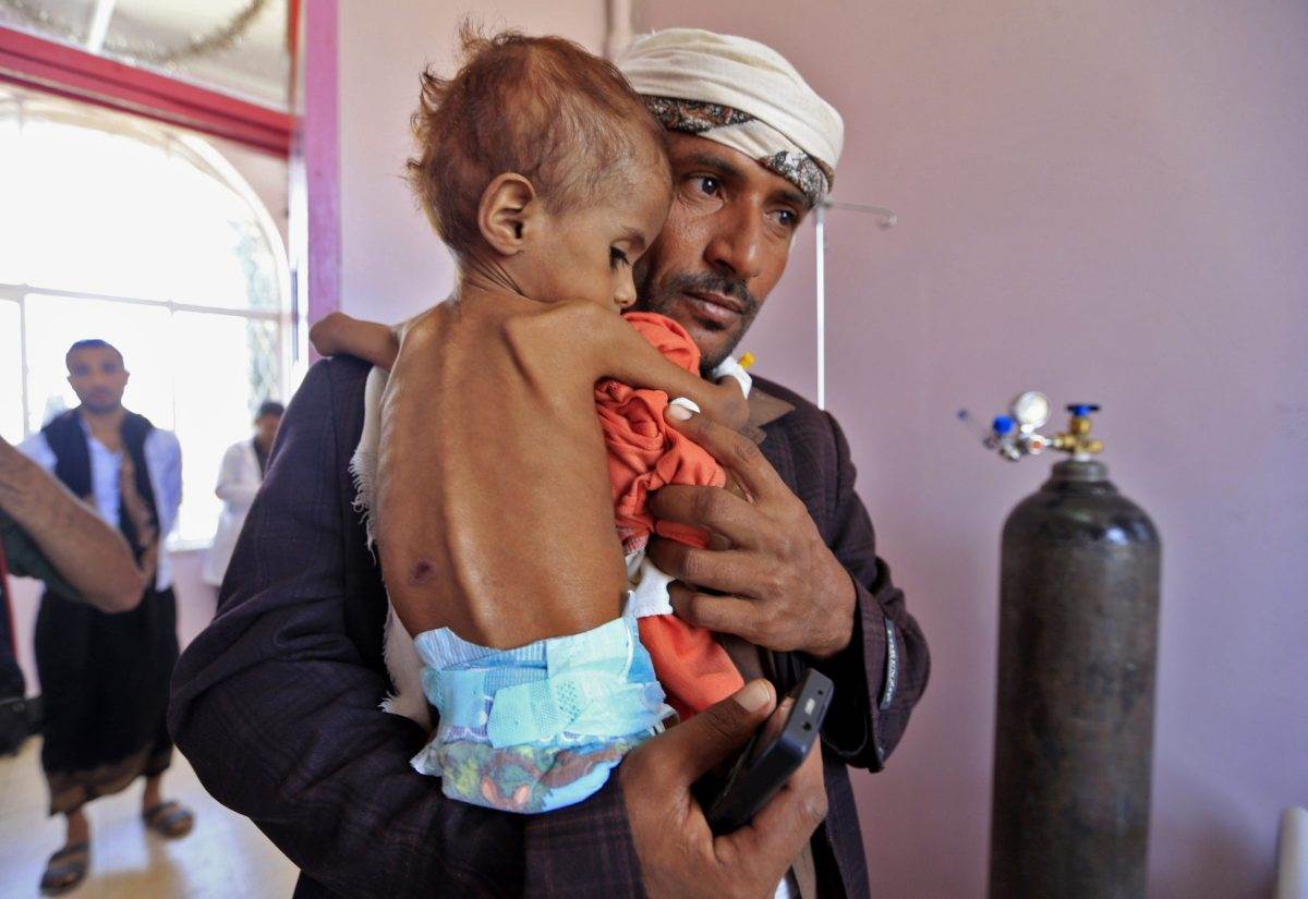   الصحة العالمية ومركز سلمان للإغاثة يواصلان مكافحة سوء تغذية الأطفال فى اليمن